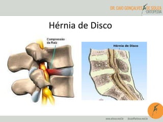 Hérnia de Disco
 