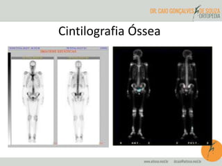 Cintilografia Óssea
 