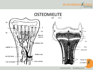 OSTEOMIELITE 
 