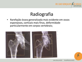 Radiografia 
• Rarefação óssea generalizada mais evidente em ossos 
esponjosos, corticais mais finas, deformidade 
particularmente em corpos vertebrais; 
 