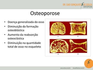 Osteoporose 
• Doença generalizada do osso 
• Diminuição da formação 
osteoblástica 
• Aumento da reabsorção 
osteoclástica 
• Diminuição na quantidade 
total de osso no esqueleto 
 