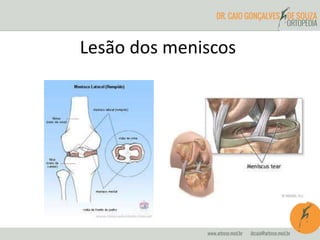 Lesão dos meniscos 
 