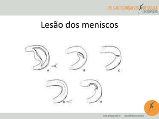 Lesão dos meniscos 
 
