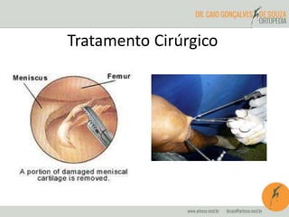 Tratamento Cirúrgico 
 
