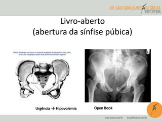 Livro-aberto 
(abertura da sínfise púbica) 
Urgência  Hipovolemia Open Book 
 
