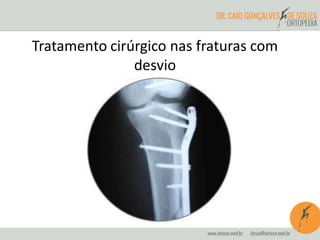 Tratamento cirúrgico nas fraturas com 
desvio 
 