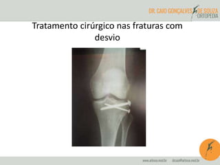 Tratamento cirúrgico nas fraturas com 
desvio 
 