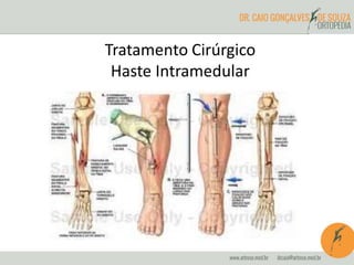 Tratamento Cirúrgico 
Haste Intramedular 
 