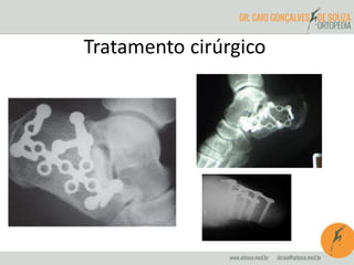 Tratamento cirúrgico 
 