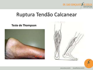 Ruptura Tendão Calcanear 
Teste de Thompson 
 