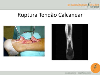 Ruptura Tendão Calcanear 
 