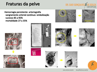 Fraturas da pelve 
Hemorragia persistente: arteriografia 
sangramento arterial contínuo: embolização 
sucesso 85 a 95% 
mortalidade 27 a 35% micromolas 
 