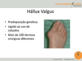 Hállux Valgus 
• Predisposição genética 
• Ligado ao uso de 
calçados 
• Mais de 100 técnicas 
cirúrgicas diferentes 
 