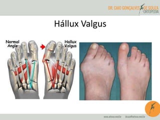 Hállux Valgus 
 