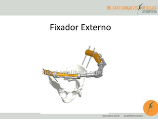 Fixador Externo 
 