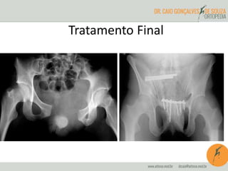 Tratamento Final 
 