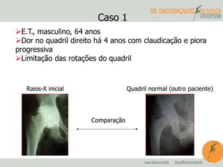 Caso 1 
E.T., masculino, 64 anos 
Dor no quadril direito há 4 anos com claudicação e piora 
progressiva 
Limitação das rotações do quadril 
Raios-X inicial Quadril normal (outro paciente) 
Comparação 
 