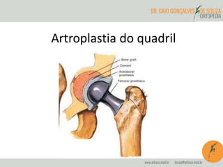 Artroplastia do quadril 
 