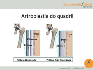 Artroplastia do quadril 
 