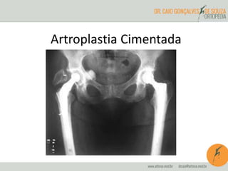 Artroplastia Cimentada 
 
