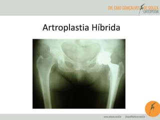 Artroplastia Híbrida 
 