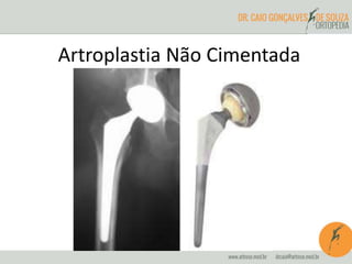Artroplastia Não Cimentada 
 