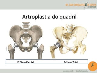 Artroplastia do quadril 
 