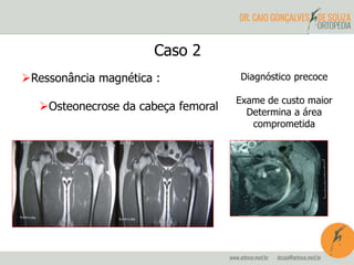 Caso 2 
Ressonância magnética : 
Osteonecrose da cabeça femoral 
Diagnóstico precoce 
Exame de custo maior 
Determina a área 
comprometida 
 