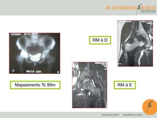 Mapeamento Tc 99m 
RM à D 
RM à E 
 