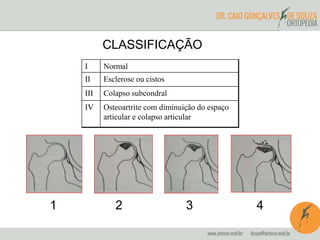 CLASSIFICAÇÃO 
I Normal 
II Esclerose ou cistos 
III Colapso subcondral 
IV Osteoartrite com diminuição do espaço 
articular e colapso articular 
1 2 3 4 
 