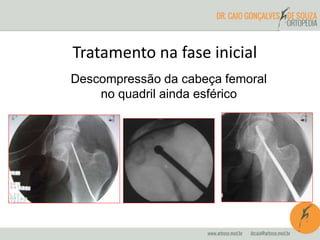 Tratamento na fase inicial 
Descompressão da cabeça femoral 
no quadril ainda esférico 
 