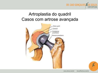 Artroplastia do quadril 
Casos com artrose avançada 
 