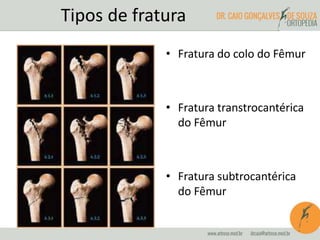 Tipos de fratura 
• Fratura do colo do Fêmur 
• Fratura transtrocantérica 
do Fêmur 
• Fratura subtrocantérica 
do Fêmur 
 