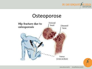 Osteoporose 
 