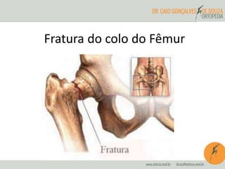 Fratura do colo do Fêmur 
 