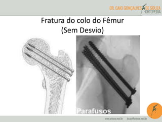 Fratura do colo do Fêmur 
(Sem Desvio) 
 