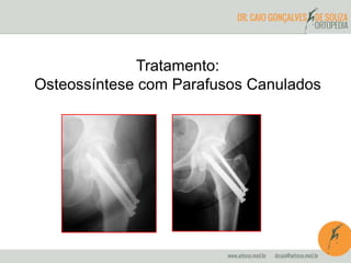 Tratamento: 
Osteossíntese com Parafusos Canulados 
 