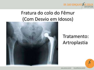 Fratura do colo do Fêmur 
(Com Desvio em Idosos) 
Tratamento: 
Artroplastia 
 