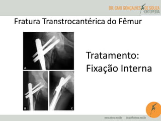 Fratura Transtrocantérica do Fêmur 
Tratamento: 
Fixação Interna 
 