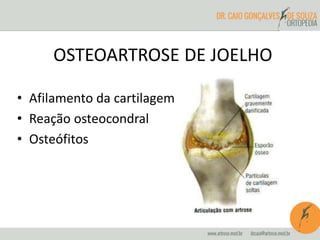 OSTEOARTROSE DE JOELHO 
• Afilamento da cartilagem 
• Reação osteocondral 
• Osteófitos 
 
