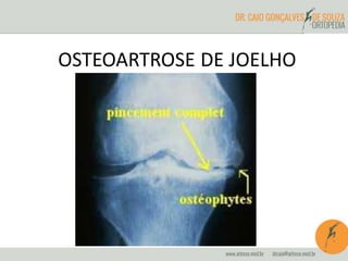 OSTEOARTROSE DE JOELHO 
 