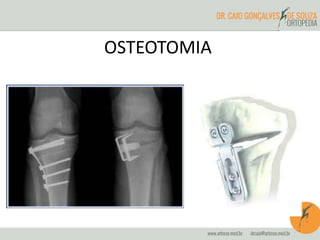 OSTEOTOMIA 
 