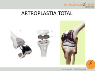 ARTROPLASTIA TOTAL 
 