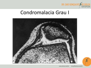 Condromalacia Grau I 
 