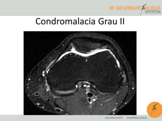 Condromalacia Grau II 
 