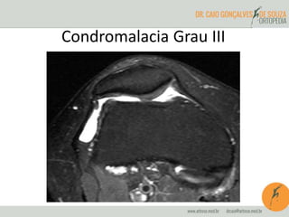 Condromalacia Grau III 
 