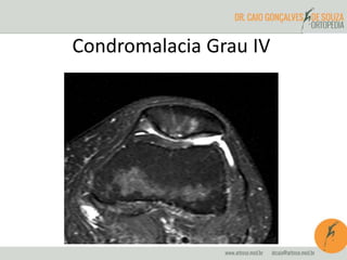 Condromalacia Grau IV 
 