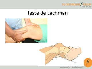 Teste de Lachman 
 
