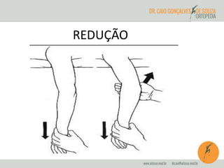 REDUÇÃO 
 