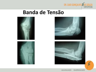 Banda de Tensão 
 